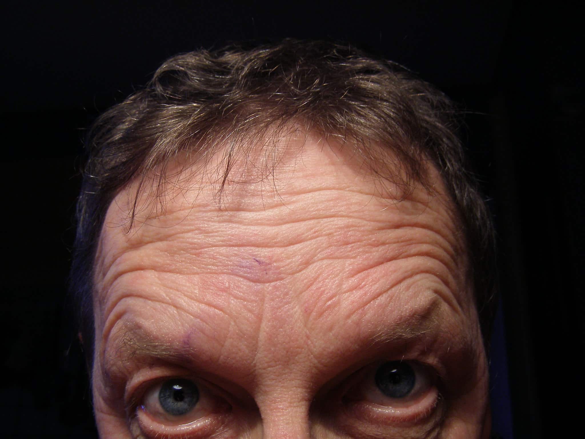 Post-Covid-19-Erkrankung